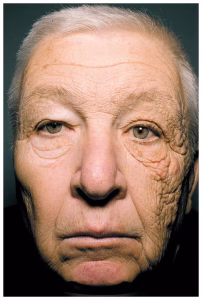 Close-up of an elderly man showing severe sun damage on the right side of his face and significantly less aging on the left side due to sunscreen protection.