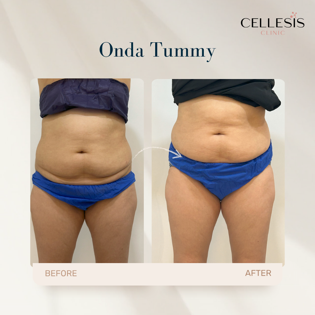With Onda Pro Coolwaves, you can achieve smoother skin and reduced cellulite. These before and after images highlight the effectiveness of the treatment in sculpting and tightening areas of the body.