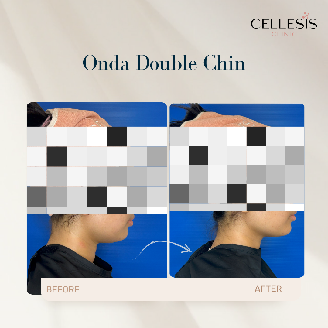 Before and after results of Onda Pro Coolwaves for double chin, showing fat loss and improved skin elasticity.