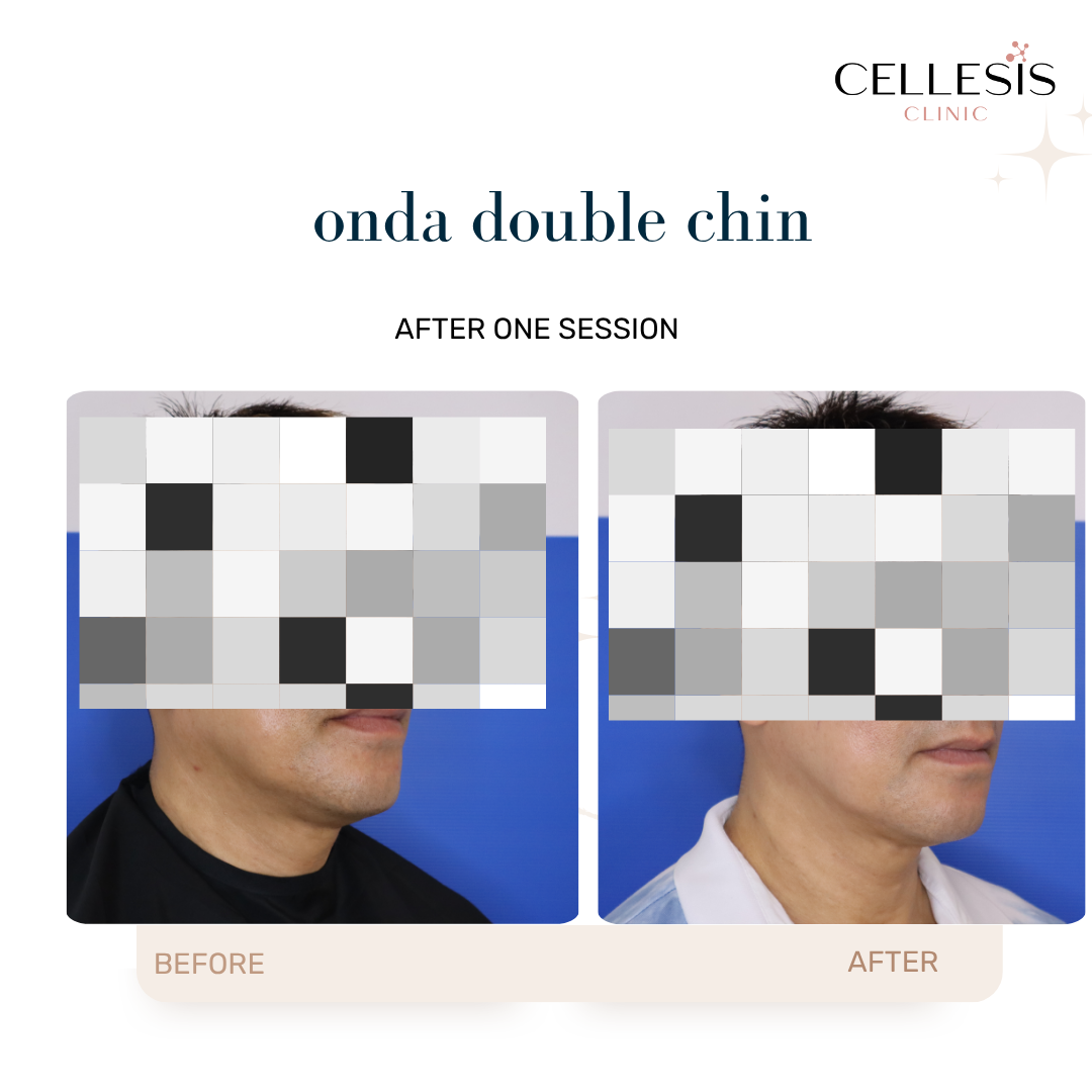 Before and after results of Onda Pro Coolwaves treating double chin, showing noticeable fat reduction and skin tightening.
