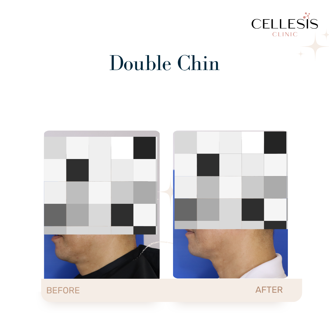 Onda Pro Coolwaves before and after showing visible improvement in double chin reduction and skin firming.