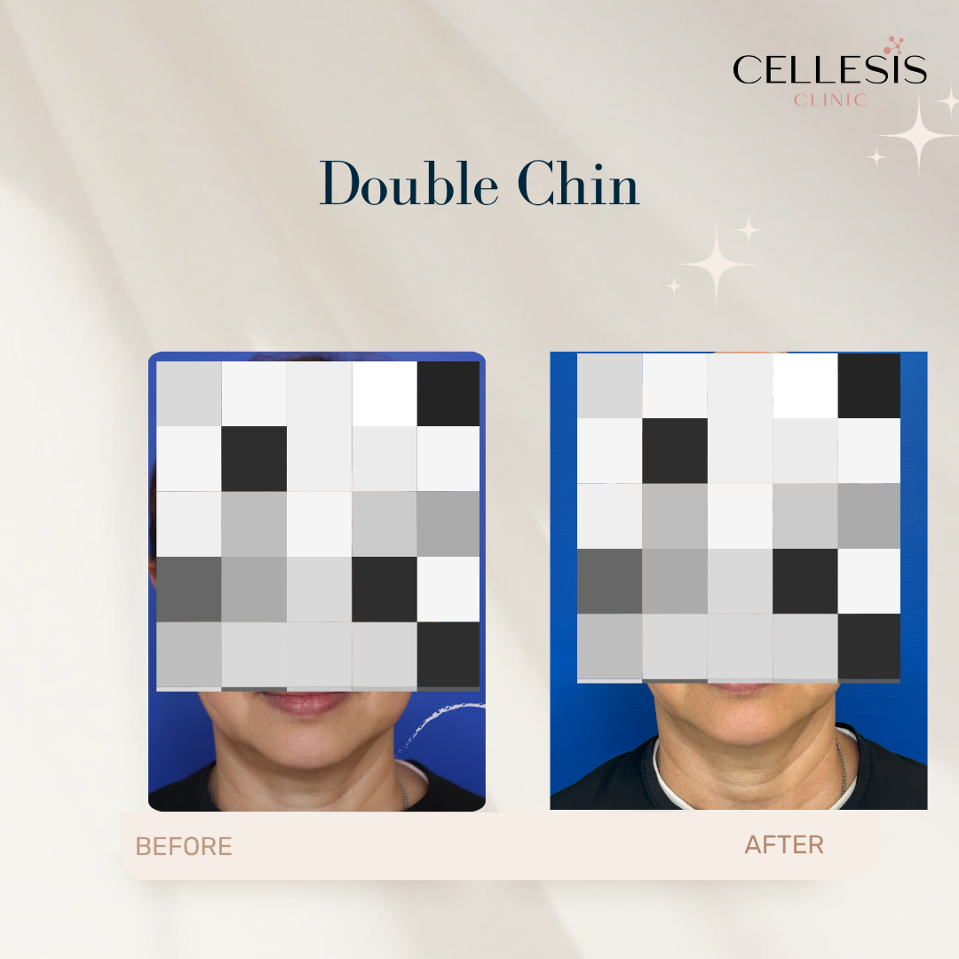 Visible results of Onda Pro Coolwaves treatment on double chin, reducing fat and tightening loose skin.