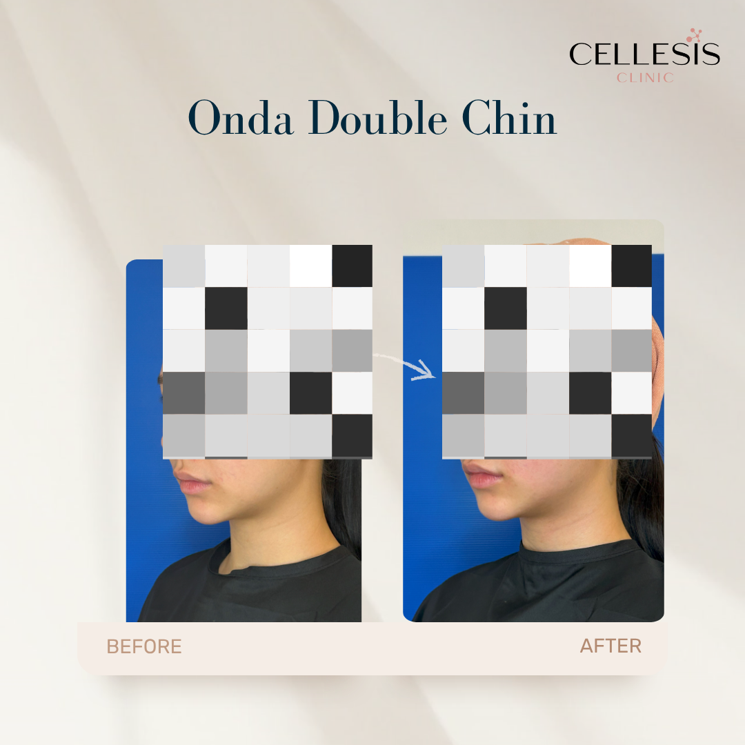 Onda Pro Coolwaves before and after showing reduction in double chin and tighter skin around the jaw.