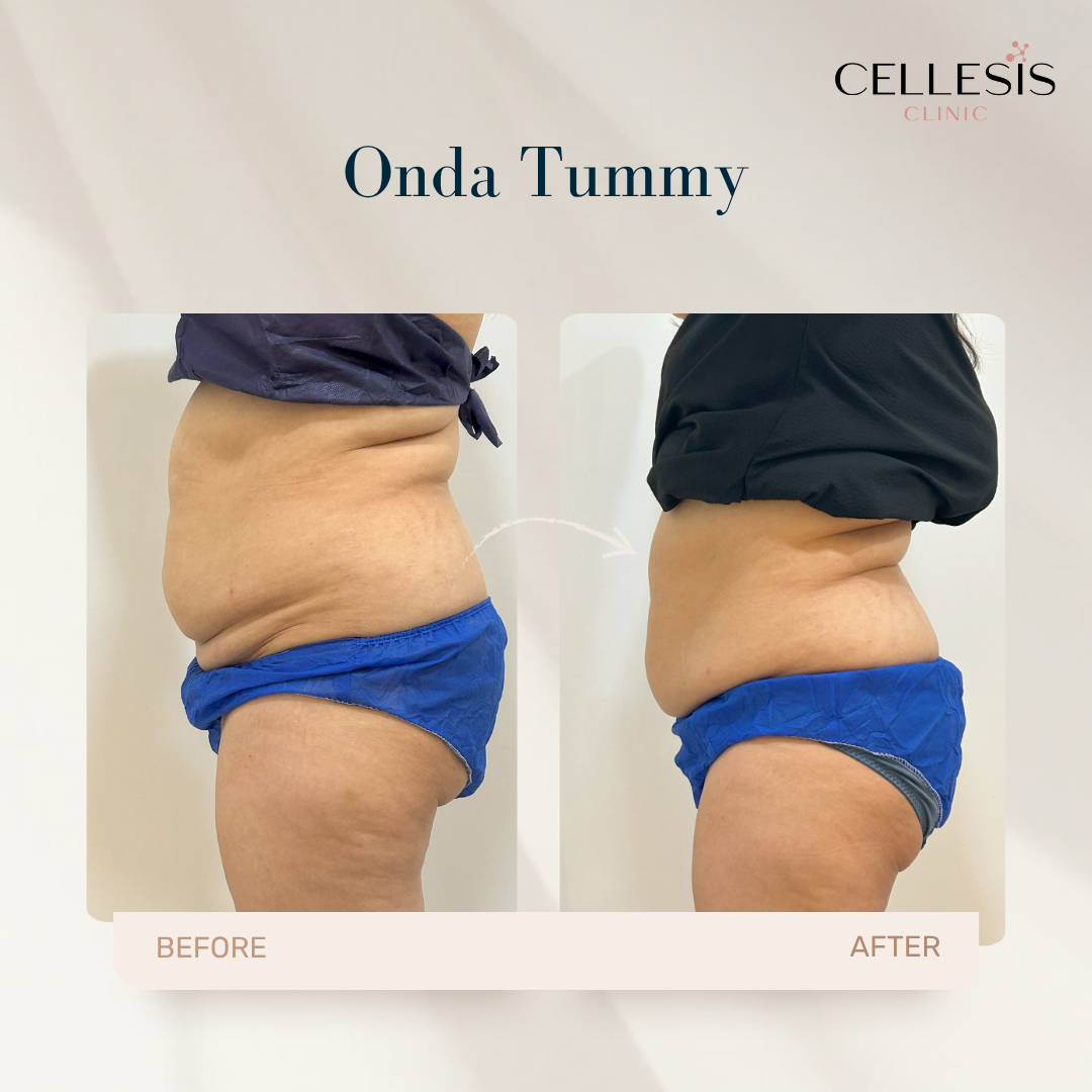 Before and after treatment results of Onda Pro Coolwaves showing enhanced body definition and smoother skin.