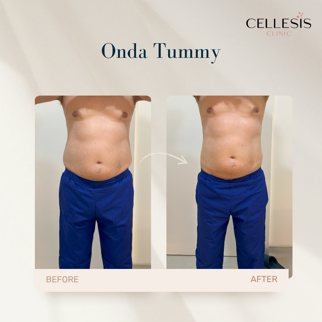 Onda Pro Coolwaves treatment before and after, showing visible improvements in skin tightness and fat reduction.